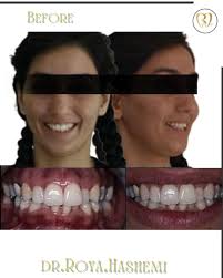 Non Extradition orthodontic treatment. And preparing the space for the  implant placement in the lower arch. ارتودنسي بدون كشيدن دندان و اماده سازي  فضا جهت استقرار ايمپلنت در فك پايين. #ارتودنسي_نامرئي #