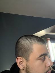 Temple recession anything I can do to save it? : r/malehairadvice