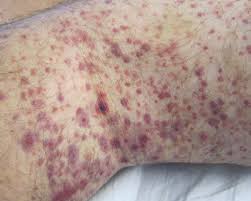 At initial stages, bruises are seen purplish red. Man With A Diffuse Palpable Rash Consultant360