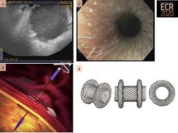 Axios™ stent and electrocautery enhanced delivery system animation. Epos Trade