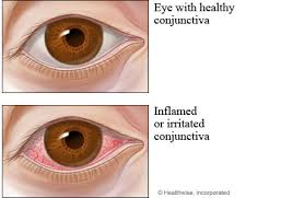Image result for Conjunctivitis Resources