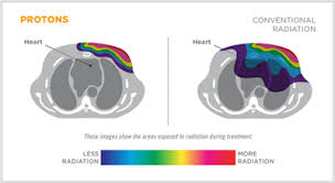 Your doctor will want to discuss treatment options as well as the prognosis for bladder cancer. Breast Cancer Treatments And Heart Health New Information On The Impact Of Radiation Seattle Cancer Care Alliance