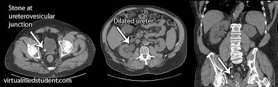 Virtualmedstudent Com Nephrolithiasis Kidney Stones Nephrolithiasis Medical Pictures Kidney Stones