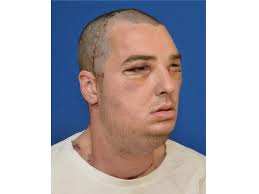 As i jam out, i get a strong sonic face transplant interview and performance at the victory lounge, seattle washington, february 10th, 2017. Face Transplant For Va Man Called Most Extensive Ever By Doctors Cbs News