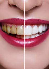 Bleach is the generic name for any chemical product that is used industrially and domestically to remove color from a fabric or fiber or to clean or to remove stains in a process called bleaching. Zahnarztpraxis Fur Bleaching In Munchen Jetzt Informieren