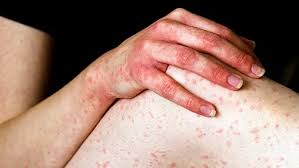 Image result for Anaphylaxis