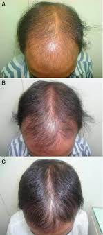 Vitamin d is critical to preventing hair loss. Controlled Clinical Trial For Evaluation Of Hair Growth With Low Dose Cyclical Nutrition Therapy In Men And Women Without The Use Of Finasteride