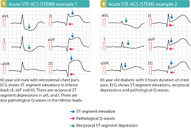 Stemi results from complete and … Ecg Signs Of Myocardial Infarction Pathological Q Waves Pathological R Waves Ecg Echo