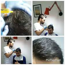 57 Begenme 3 Yorum Instagram Da Dr Nedim Yildiz Dr Nedimyildiz 3 Seans Muhtesem Sonuc Daha Onceki Seanslar Paylasmlarda Mevcuttur Prp Plate