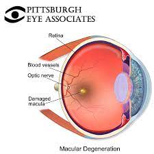 Macular Degeneration - Pittsburgh Eye Associates