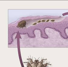 Image result for Sarcoptes scabiei life cycle