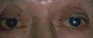 Approximately 5 to 10 percent of all skin cancers occur in the eyelid. Melanoma Brown Pigmented Eyelid Lesion