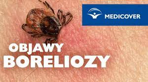 Jeżeli gospodarka wodna naszego ciała zostaje zachwiana, pojawiają się objawy przynoszące nam dyskomfort oraz widoczne zmiany w organizmie. Borelioza Objawy Boreliozy Youtube