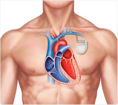 Learn about pacemakers, including the difference between transvenous and leadless (wireless) pacemakers, why you may need one, how they're placed, and information about living with the device. What Is A Pacemaker