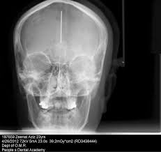 Severe copper beaten skull appearance is present which is more remaniscient of a lacunar skull, however no myelomeningocoele is present (i.e not a chiari ii malformation) and axial imaging. Figure 6