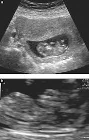 So i think i have over google searched and scared myself to ridiculous levels but according to several websites a nt scan at 12 weeks has a 5% false positive rate. Is Nuchal Translucency A Useful Aneuploidy Marker In Fetuses With Crown Rump Length Of 28 44 Mm Grande 2014 Ultrasound In Obstetrics Amp Gynecology Wiley Online Library