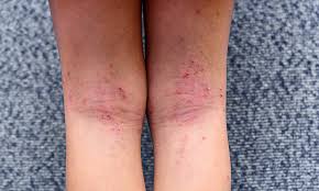 Image result for Atopic eczema atopic dermatitis