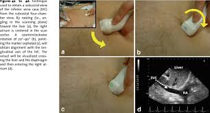 A To 4d Technique Used To Obtain A Subcostal View Of The Inferior Vena Download Scientific Diagram