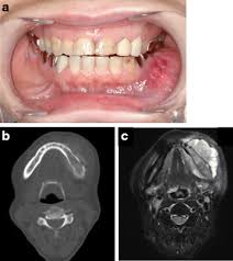 Osteosarcoma is the most common type of cancer that begins in you or your teenager's bones, usually in the arms or legs. Conventional Osteosarcoma Of The Mandible Successfully Treated With Radical Surgery And Adjuvant Chemotherapy After Responding Poorly To Neoadjuvant Chemotherapy A Case Report Journal Of Medical Case Reports Full Text