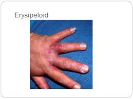 Image result for Erysipeloid