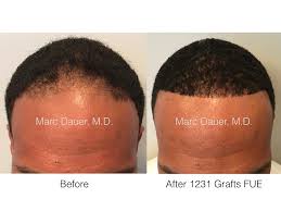 His techniques and equipment are the latest state of the art surgical options available in the world. Fue Hair Transplant In African American Patient Marc Dauer Md Hair Transplant Doctor Los Angeles