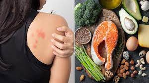 It mistakes it as a harmful substance and launches an attack by releasing chemicals such as histamine when an allergen enters the body again. Can The Keto Diet Help Treat Eczema Everyday Health