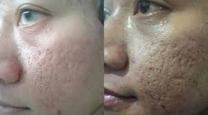 Subsisi kolagen , dapat di lakukan sebagai tambahan customize treatment untuk beberapa pasien dan hanya di butuhkan 1x treatment untuk hasilnya. Atasi Bopeng Di Wajah Dengan Dermal Punch Health Liputan6 Com