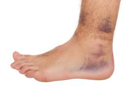 Why Rest Is A Must For A Sprained Ankle: David B Glover, Dpm, Facfas:  Podiatric Foot And Ankle Surgeon