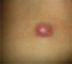 Image result for Dermatofibrosarcoma Protuberans