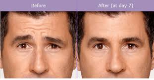These are the main ingredients that will help the appearance of the lines. Forehead Wrinkles Botox Or Dermal Fillers