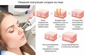 как избавиться от лопнувших капилляров на лице в домашних условиях Sosudistye Zvezdochki Na Lice Lechenie V Salone Narodnymi Metodami