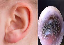 Black fungus dried mushrooms organic auricularia wood ear 黑木耳 mushrooms 100~500g. Mould Found Growing In Boy S Ear Canal Said To Be Due To Wearing Earphones Too Often Lifestyle News Asiaone