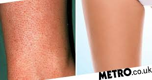 Wrinkles, dark spots, elasticity), keratosis pilaris should actually improve with view image. How To Get Rid Of Strawberry Legs Metro News