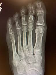 A page for people like me who were born with an overlapping fifth toe. Dr Mehmet Oz On Twitter I Fractured A Bone In My Foot After Stubbing My Toe Last Week Who Else Has Fractured A Bone This Way And Can Anyone Make Out