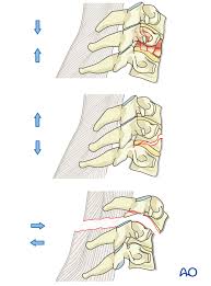 Image result for Subaxial Injury Classification Scale