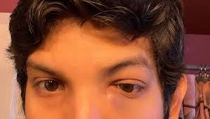 Fundraiser by Christian Rugel : Linfoma Maligno (Cáncer) en la piel cerca  del ojo izquierdo