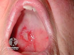 Image result for Pemphigoid