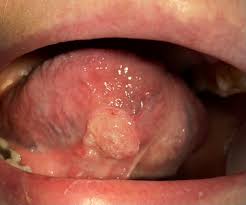 Image result for papillomavirus tongue)
