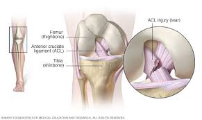 A fold of peritoneum or other membranes. Acl Injury Symptoms And Causes Mayo Clinic