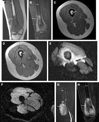 Diagnosed with benign (n = 29) or malignant (n = 18) bone tumors . Multiparametric Mr Imaging Of Benign And Malignant Bone Lesions Magnetic Resonance Imaging Clinics
