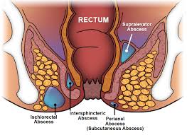 Fistulas are usually the result of an injury or surgery. Abscess And Fistula Expanded Information Ascrs
