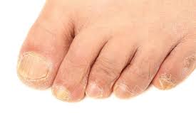 Foot fungus (or different called ringworm of the foot, tinea pedis, tinea pedum, as well as moccasin foot) is a mutual as well as infectious dermatophytes fungi contamination of the skin that causes. What Causes Toenail Fungus And How Can I Get Rid Of It Jennifer Tauber Dpm Podiatrist