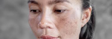 Hydroquinone for Melasma: Your Go-To Topical Treatment — Articles — We Care  For Skin