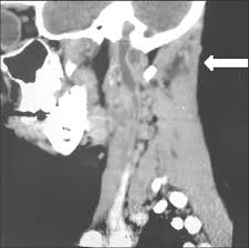El valor de la tac de tórax helicoidal para el diagnóstico de tromboembolismo pulmonar depende si puede excluirse trombosis venosa profunda por arm de pelvis y mi, la presencia de embolias. Tac Con Contraste La Flecha Muestra La Trombosis De La Vena Yugular Download Scientific Diagram