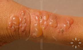 Image result for Pemphigoid