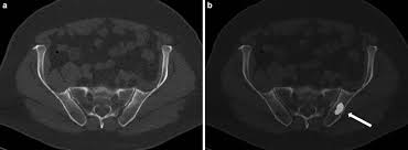 The spread may be very rapid, as in this case, where it took only eight months since … Solitary Bone Metastasis In The Left Iliac Bone Arrow Of A Download Scientific Diagram