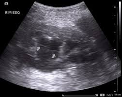 Image result for Perinephric Abscess