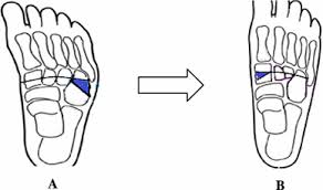 The cause is not known. Combined Double Tarsal Wedge Osteotomy And Transcuneiform Osteotomy For Correction Of Resistant Clubfoot Deformity The Bean Shaped Foot Springerlink