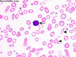 Pencil cells and prekeratocytes in iron deficiency anemia. Histopathology Images Of Anemia Iron Deficiency By Pathpedia Com Pathology E Atlas