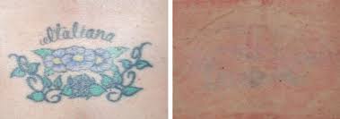 The best laser tattoo removal begins with seattle's most advanced laser. Laser Tattoo Removal Picosure Laser Tattoo Removal Scar Treatment
